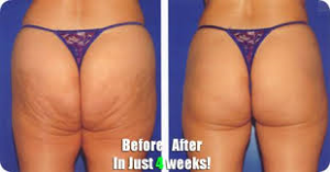 Truth about cellulite
